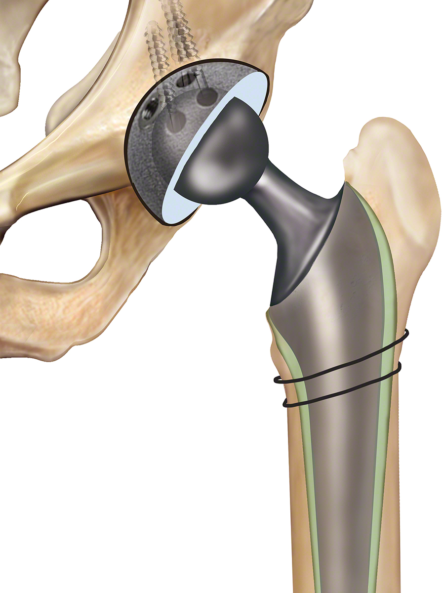 Revision Hip Replacement Dr. Anthony Spriggins